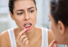 Какво е възпаление на венците? Какво е възпаление на венците